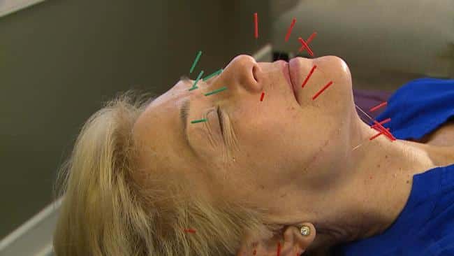 Study shows acupuncture may help reduce migraines